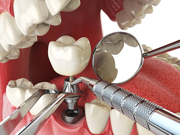 Best Urgent Dental Care for Toothache in Le Claire, IA